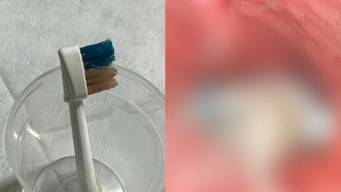 Médicos da Arábia Saudita encontraram uma escova elétrica no trato digestivo de uma criança de 9 anos. - Imagem: reprodução I The New York Post