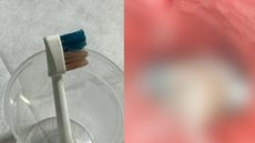 Médicos da Arábia Saudita encontraram uma escova elétrica no trato digestivo de uma criança de 9 anos. - Imagem: reprodução I The New York Post