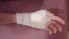 Menino machucou a mão ao brigar com criminoso para defender a mãe - Foto: Reprodução