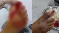 Menino sofre corte no pé em acidente no parquinho - Foto: Reprodução / Instagram
