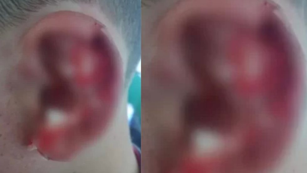Aluno autista tem pedaço da orelha arrancado durante briga na escola - Imagem: reprodução Metrópoles
