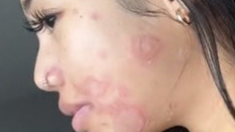 Louaira Dela Cruz mostra os efeitos da infecção em seu rosto - Imagem: reprodução/TikTok @louaira