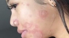 Louaira Dela Cruz mostra os efeitos da infecção em seu rosto - Imagem: reprodução/TikTok @louaira