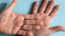 Grande ABC registra primeiros casos de Mpox em 2026 - Imagem: Reprodução
