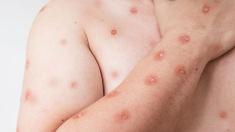 Lesões típicas da mpox, identificadas pela rede de saúde - Imagem: Divulgação | Ministério da Saúde