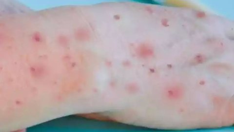 São Paulo confirma primeiro caso brasileiro de Mpox - Imagem: Reprodução