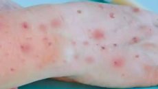 São Paulo confirma primeiro caso brasileiro de Mpox - Imagem: Reprodução