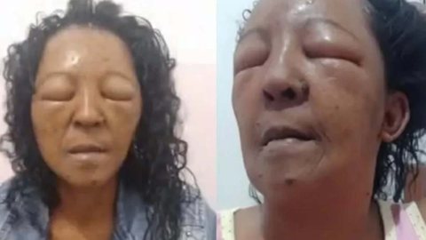 Mulher fica com o rosto inchado após tratamento no cabelo - Foto: Reprodução / Globo