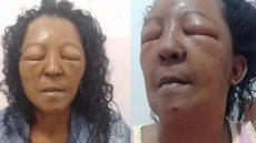 Mulher fica com o rosto inchado após tratamento no cabelo - Foto: Reprodução / Globo