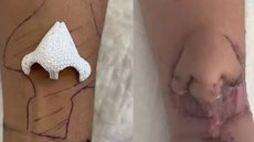 As imagens do nariz sendo cultivado no braço da paciente viralizaram na internet na última semana - Imagem: reprodução CHU Toulouse