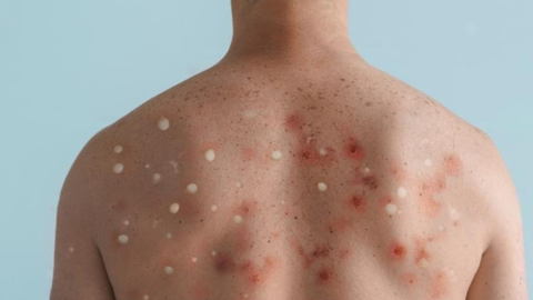 Lesões na pele costumam aparecer nos primeiros dias da infecção - Imagem: Reprodução