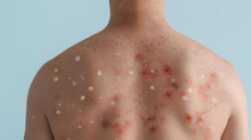 Lesões na pele costumam aparecer nos primeiros dias da infecção - Imagem: Reprodução