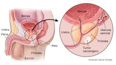 A função da próstata é produzir o fluído que protege e nutre os espermatozoides no sêmen, tornando-o mais líquido - Imagem: reprodução American Cancer Society