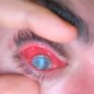Mike Krumholz perdeu a visão de um dos olhos que foi devorado por parasita - Imagem: Reprodução/TikTok