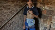 Alexandre, de 40 anos, recebe 20 bolsas a cada 2 meses - Imagem: reprodução Pedro Trindade/Inter TV Cabugi