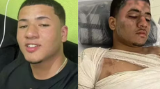Suspeito precisou ficar internado após sofrer queimaduras no corpo - Imagem: Reprodução
