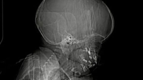 Imagens de raio-x mostram bala alojada em cérebro de bebê de 1 ano e estado da criança é surpreendente - Imagem: reprodução g1