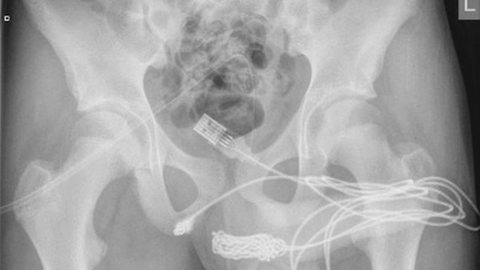 Exame de raio-X mostrou o quanto o cabo USB penetrou no corpo do adolescente - Imagem: reprodução/Urology Case Reports