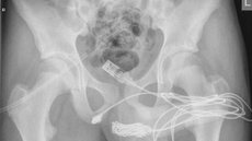 Exame de raio-X mostrou o quanto o cabo USB penetrou no corpo do adolescente - Imagem: reprodução/Urology Case Reports