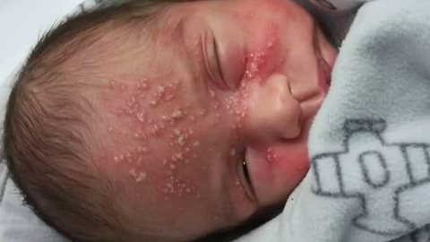 Alerta! Recém-nascido é internado às pressas após receber beijo de visita - Imagem: reprodução Facebook