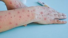 São Paulo registra 41 novos casos de mpox em uma semana - Imagem: Reprodução / X / @Metropoles