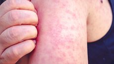 A maioria das infecções por sarampo tem ocorrido em pessoas não vacinadas. - Imagem: Reprodução.