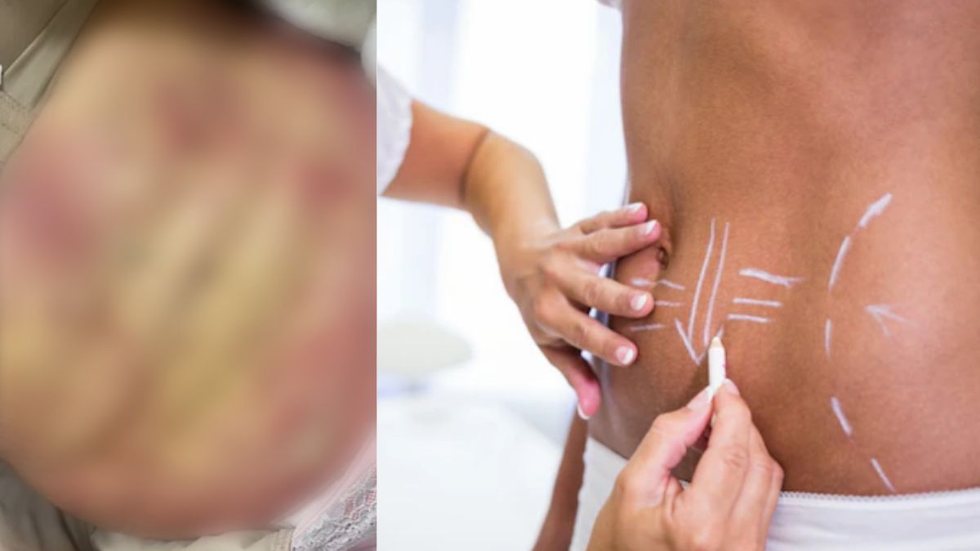 Uma mulher ficou com o corpo irreconhecível após passar por cirurgias estéticas. - Imagem: reprodução I G1 [arquivo pessoal] e Freepik