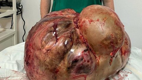 Tumor com cerca de 46 kg é retirado de paciente em Itaperuna (RJ) - Imagem: Divulgação/Glacio Boecheat