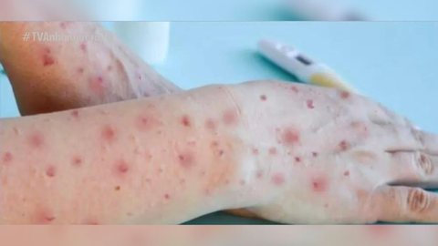 Prefeitura de SP confirma primeiros casos de varíola dos macacos em crianças na cidade - Imagem: Reprodução | TV Anhanguera