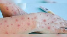 Prefeitura de SP confirma primeiros casos de varíola dos macacos em crianças na cidade - Imagem: Reprodução | TV Anhanguera