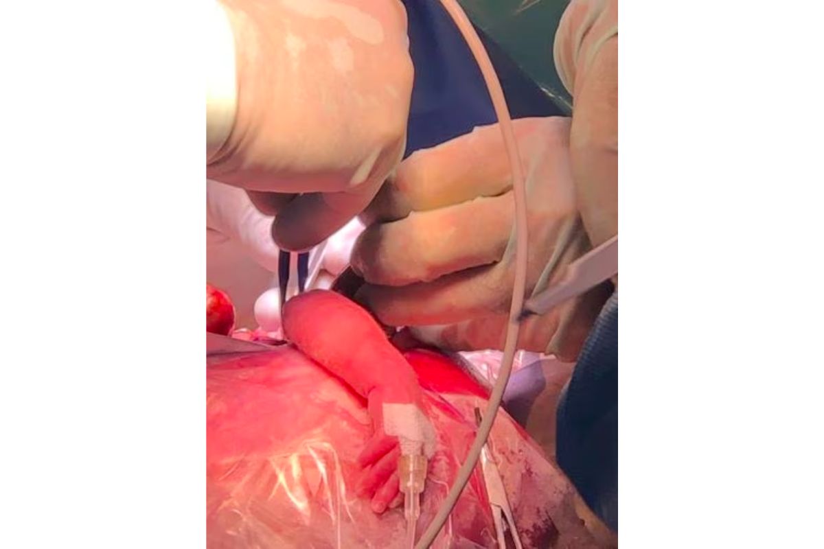 cirurgia-bebe-tumor-pulmao