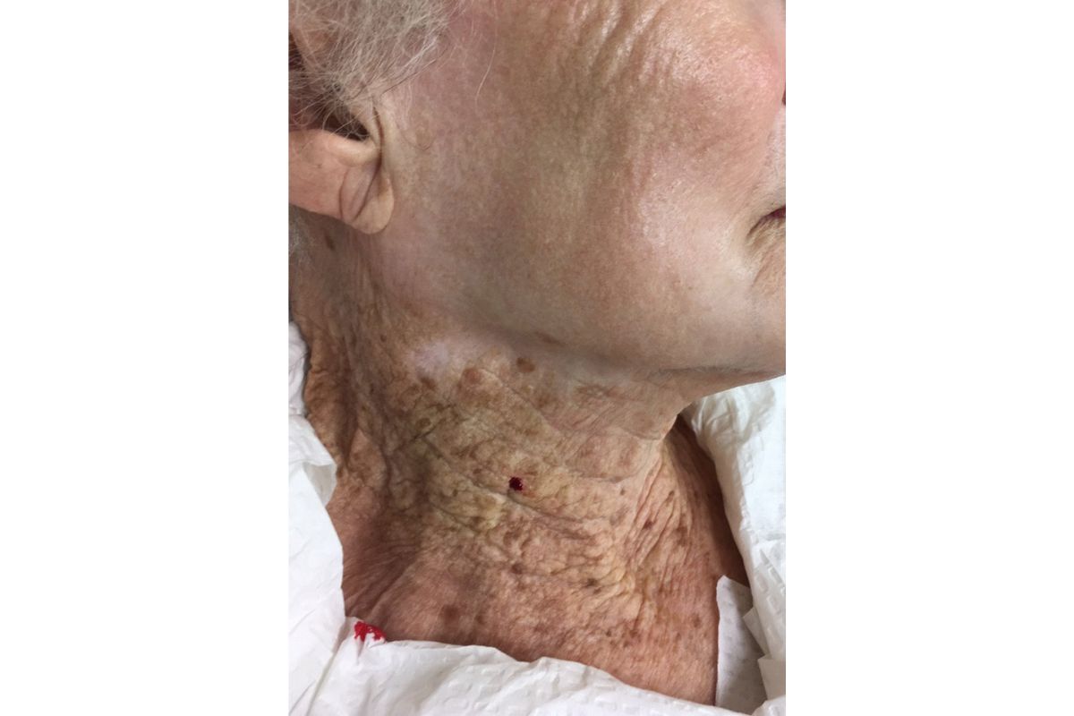 Foto de idosa que passou filtro solar somente no rosto por décadas viraliza
