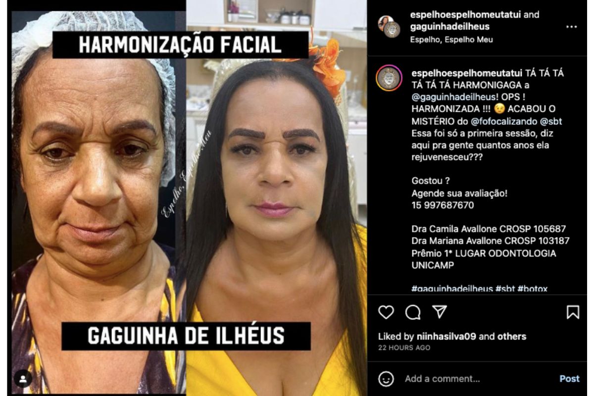 harmonizacao-facial-da-gaga-de-ilheus