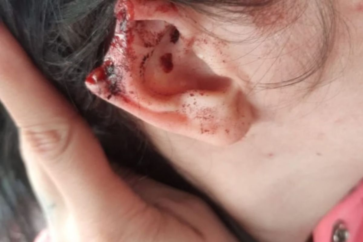 IMAGENS FORTES: homem arranca parte da orelha de namorada com mordida