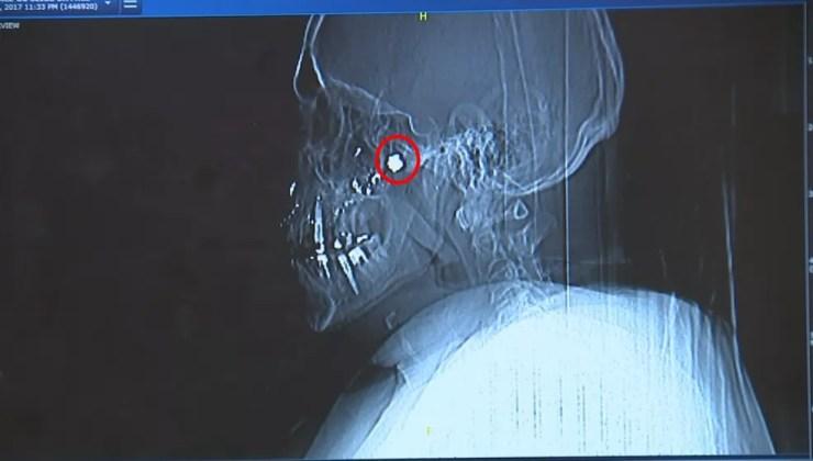 Raio X mostra por onde a bala passou e ficou alojada (Foto: Reprodução/TV TEM)