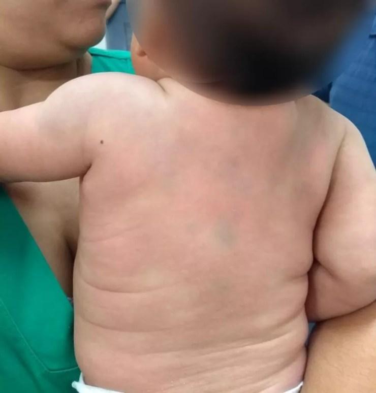 Nas imagens, é possível ver marcas roxas nas costas da criança (Foto: Polícia Militar/Divulgação)