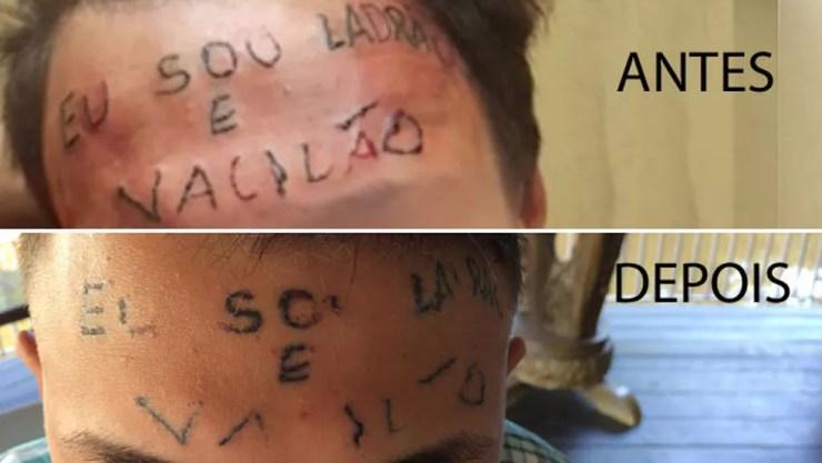 Adolescente tatuado na testa passou por três sessões para retirada da tatuagem. Veja a evolução (Foto: Glauco Araújo/G1)