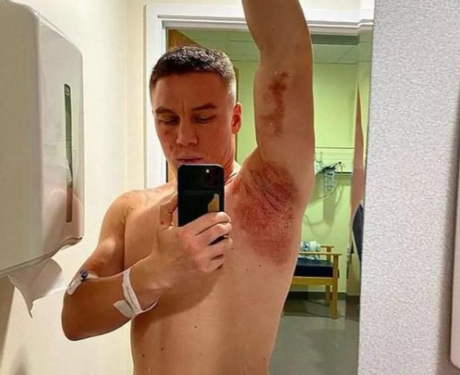 Viktor Kotochigov mostra queimaduras após ataque de ácido — Foto: Reprodução Instagram