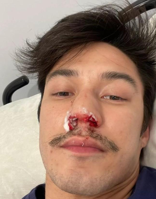 Arthur Nory mostra nariz quebrado — Foto: Reprodução/Instagram