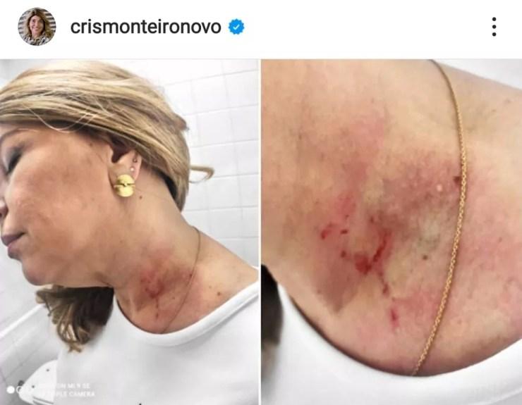 Vereadora divulgou em suas redes sociais os ferimentos  — Foto: Reprodução/Rede sociais 