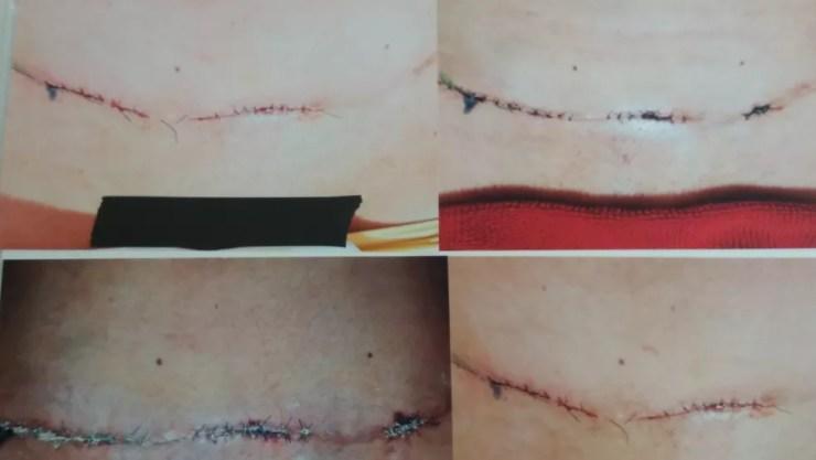 Paciente apresentou sequelas após fazer cirurgia plástica no abdômen (Foto: Jéssica Alves/G1)