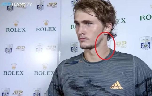 Zverev e os arranhões durante entrevista em Xangai no dia 10 de outubro — Foto: Reprodução