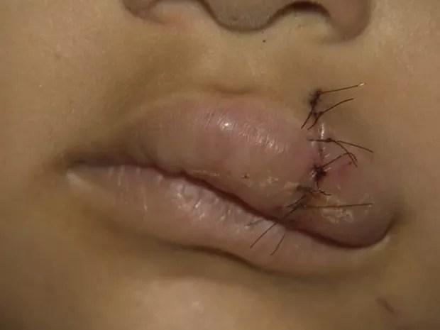 Criança levou 12 pontos nos lábios após o ataque (Foto: Reprodução/ TV TEM)