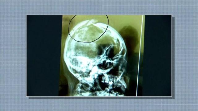 Imagem do crânio da assistente social Márcia Miranda mostra que ela levou pancada na cabeça  — Foto: Reprodução TV Globo