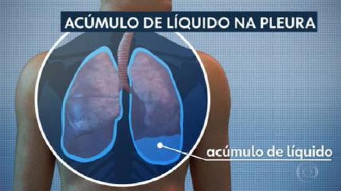Bruno Covas tem acúmulo de líquido no pulmão e abdômen