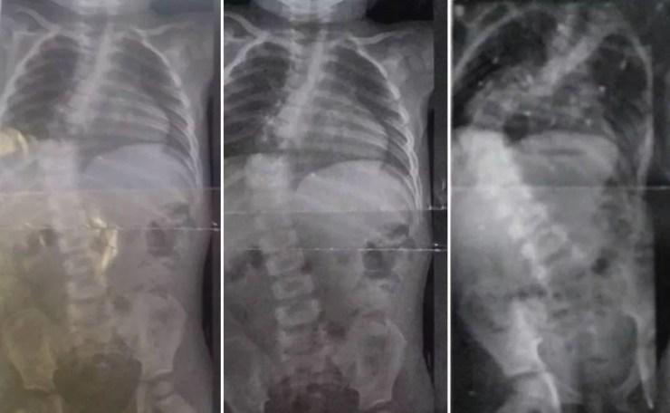 Radiografias mostram evolução de escoliose em garoto de Votorantim  — Foto: Arquivo Pessoal