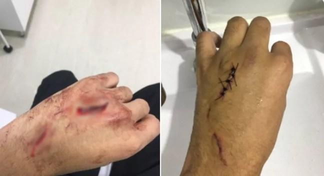 Imagens mostram ferimento na mão de jovem que sofreu tentativa de assalto na estação Trianon-Masp, da Linha 2-Verde do Metrô de São Paulo — Foto: Reprodução/Redes sociais