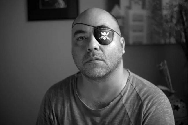 O fotógrafo Alex Silveira, que perdeu quase toda a visão do olho esquerdo após tiro de bala de borrcha em protesto — Foto: Sérgio Silva/Divulgação
