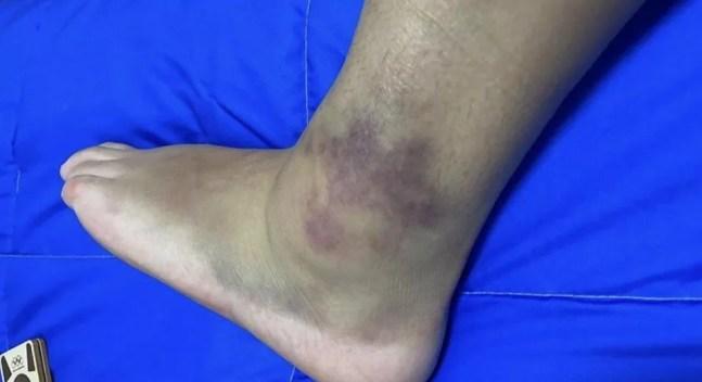 Lesão no tornozelo de Pâmela Rosa atrapalhou a performance da campeã mundial nos Jogos de Tóquio — Foto: Reprodução
