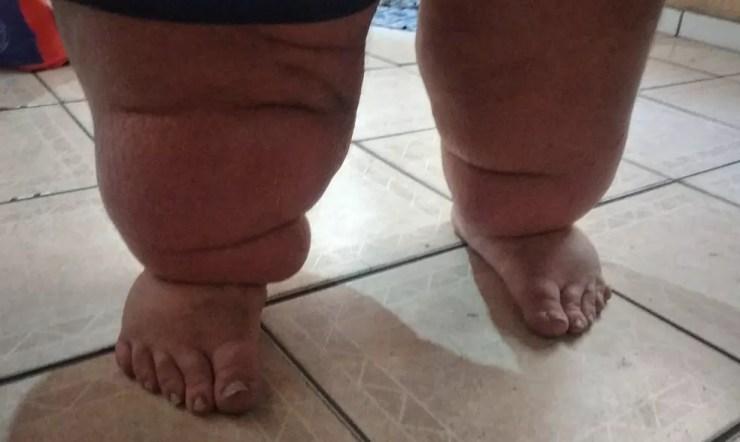 Pesando mais de 300 kg, jovem com obesidade mórbida contou que sente muitas dores nas pernas e na coluna.  — Foto: Arquivo Pessoal